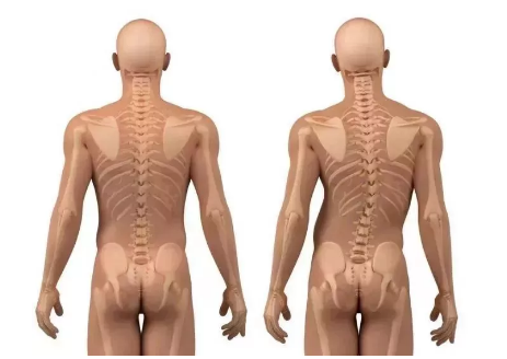 脊柱側(cè)彎 脊柱側(cè)彎