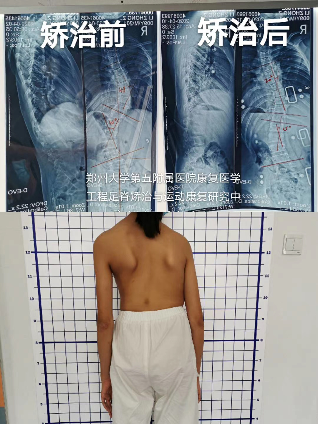 脊柱側(cè)彎矯正 脊柱側(cè)彎矯正