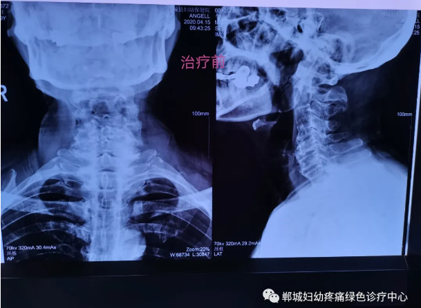 外星艙治療前 外星艙治療前